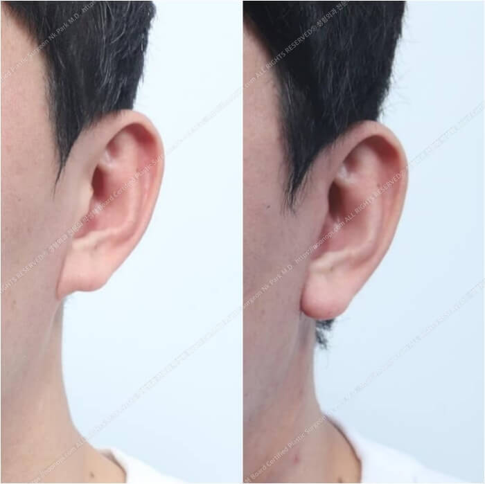 10 Things to Note About Facelift Results and Successful Before-and-After Cases image 7