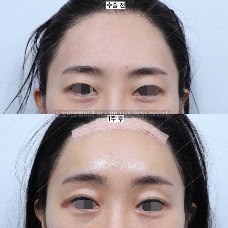 이마거상 비용과 부작용, 회복 과정에 대하여 관련 이미지 19