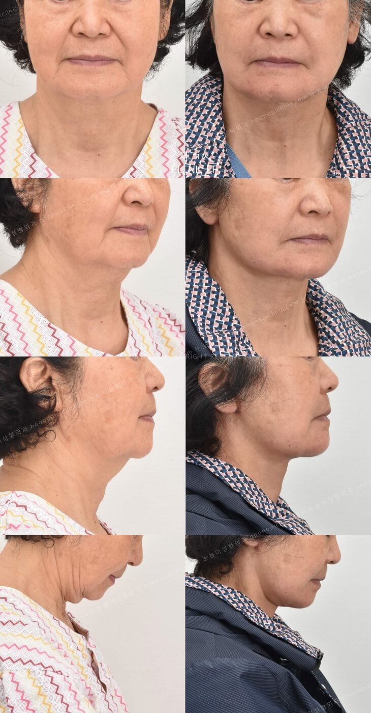 이중턱 치료 : 목거상술의 실제 효과는? 관련 이미지 5