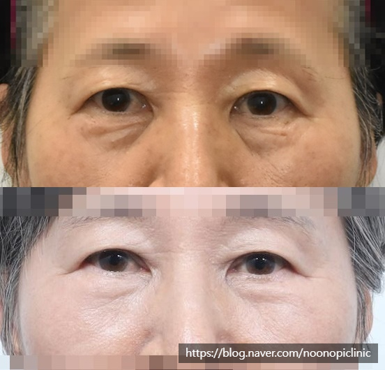 가족에게 추천한 눈밑하안검수술 24개월 경과 관련 이미지 8