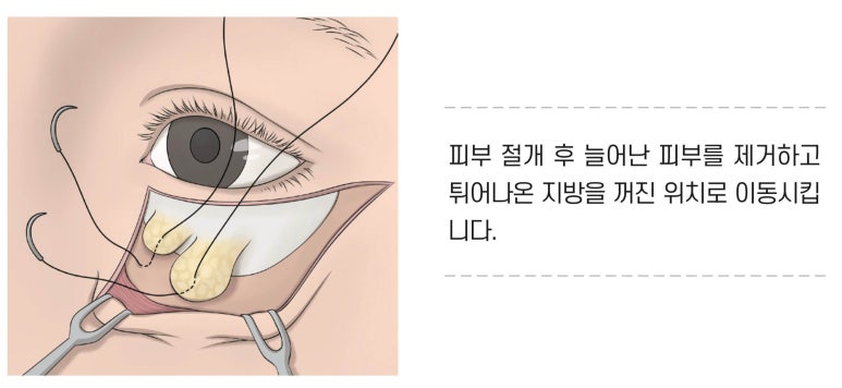 If You’re Looking Into Cosmetic Surgery as a Mother’s Day Gift for Your Parents image 9