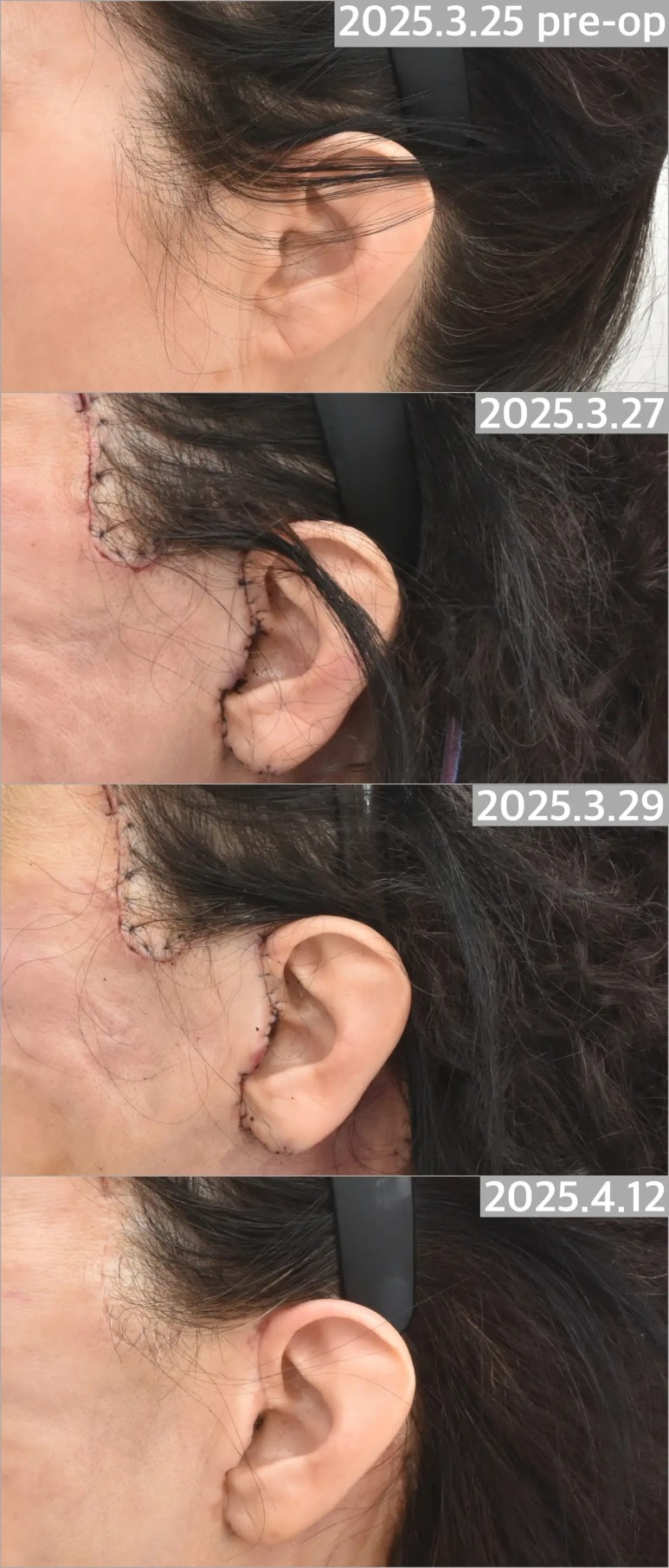 안면거상술, 흉터까지 고려하고 계신가요? 관련 이미지 4