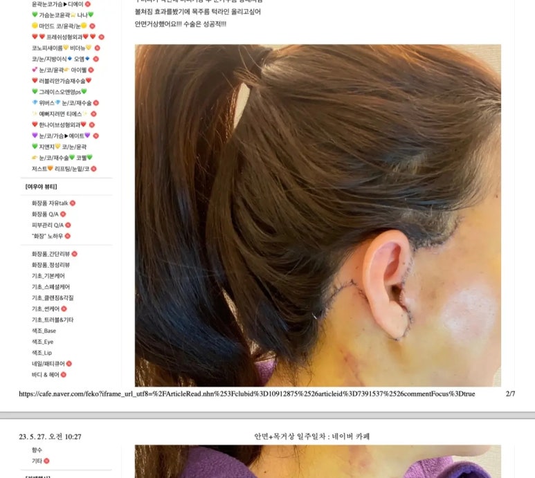 안면거상술, 흉터까지 고려하고 계신가요? 관련 이미지 11