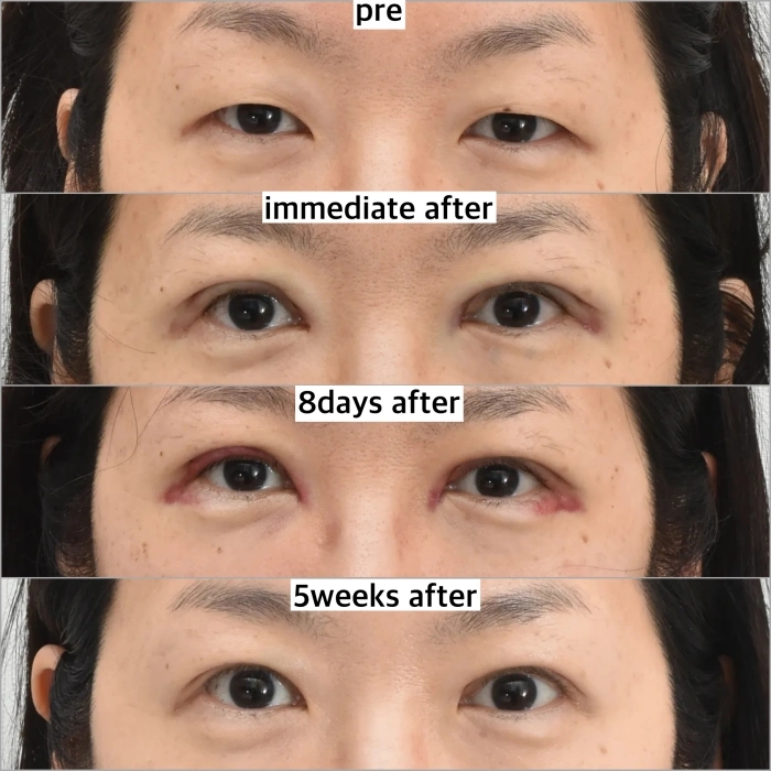 What Is Ptosis Correction? (Graphic Images Warning ⚠️) image 11