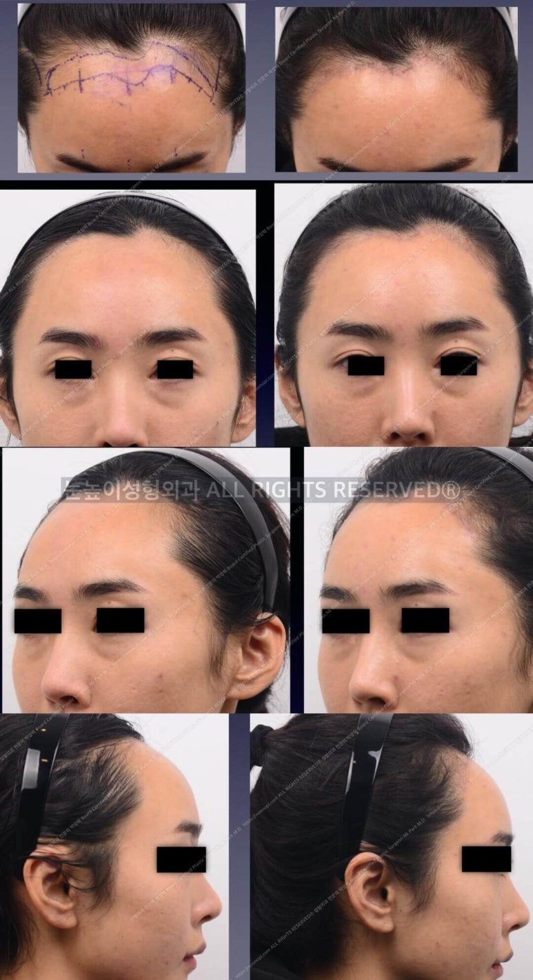 Forehead Reduction Surgery vs Hair Transplant image 14
