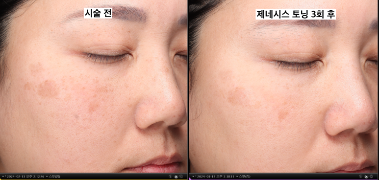 토닝 레이저 한 번으로 기미가 얼마나 좋아질까? 관련 이미지 10
