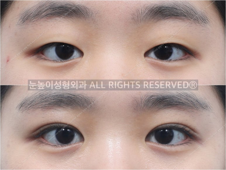성형외과 전문의가 말하는 아름다운 눈이란 관련 이미지 7