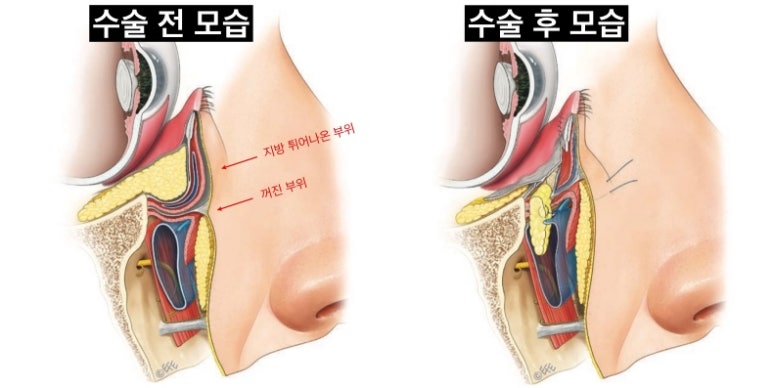 눈밑지방이식은 어떤 경우 하는 게 좋을까 관련 이미지 5