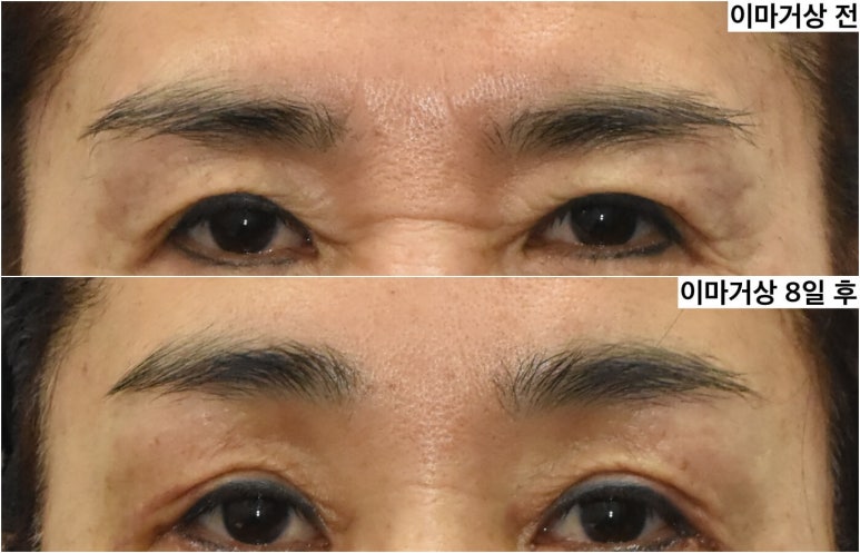 이마거상 이마주름과 미간주름 얼마나 좋아질까 관련 이미지 1