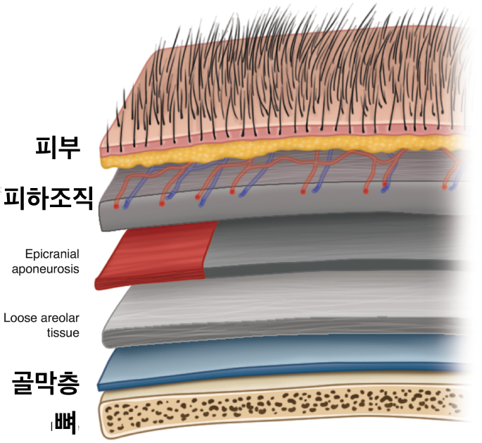Brow Lift Scars and Hair Loss image 6