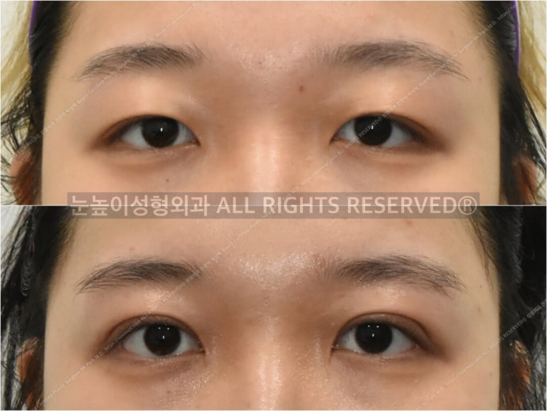 성형외과 전문의가 말하는 아름다운 눈이란 관련 이미지 16