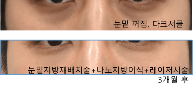 40대 눈밑지방재배치술 효과, 경과 관련 이미지 4