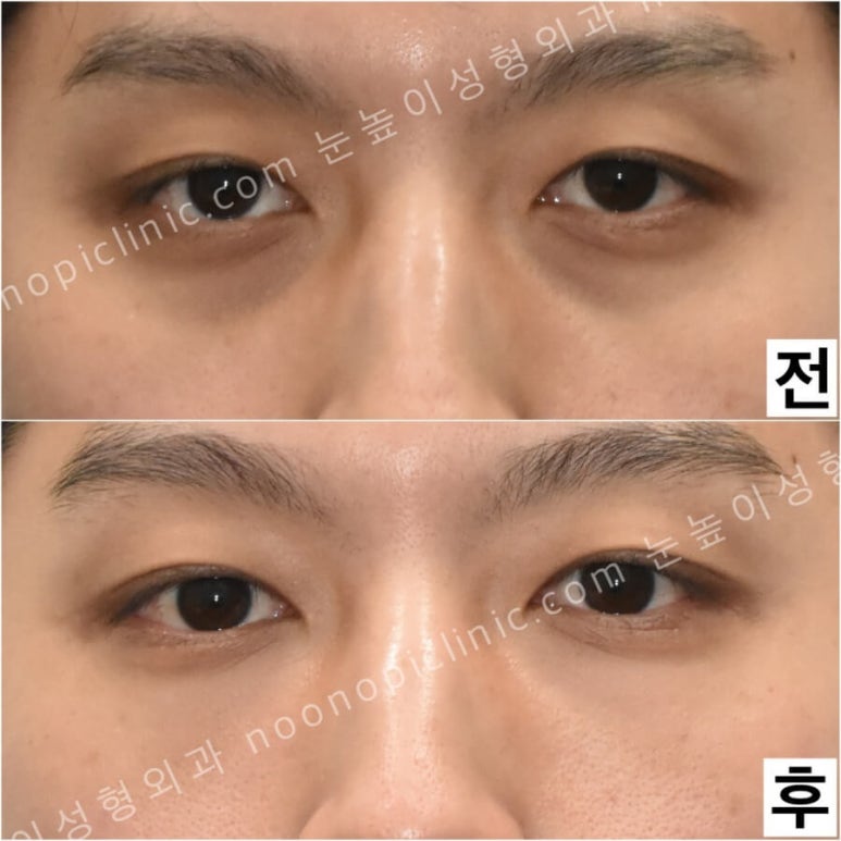 Were you curious about swelling and recovery after lower blepharoplasty? image 6
