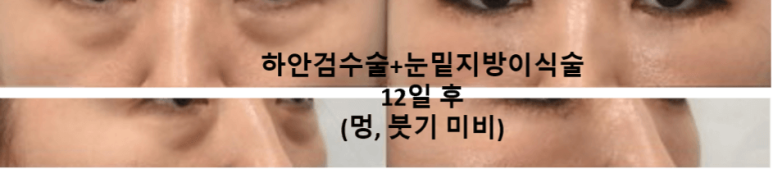 눈밑지방이식 어떤 경우에 효과적일까? 과도함, 부작용 방지 위해 관련 이미지 7