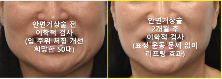 안면거상술 생각하는데 부작용 걱정 되세요? 관련 이미지 5