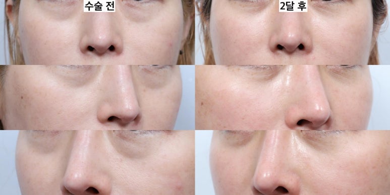 눈밑지방이식은 어떤 경우 하는 게 좋을까 관련 이미지 10