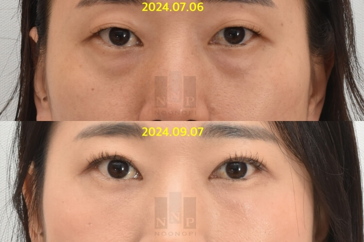 Lower Blepharoplasty vs. Fat Repositioning for Under-Eye Bags - Which Under-Eye Surgery Is Right for Me? image 7