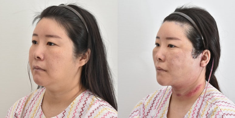 세상에서 가장 안면거상 수술을 잘하는 닥터 관련 이미지 22