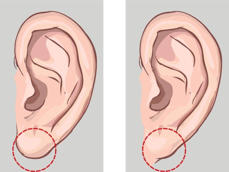 Facelift Scars and Recovery Time image 15