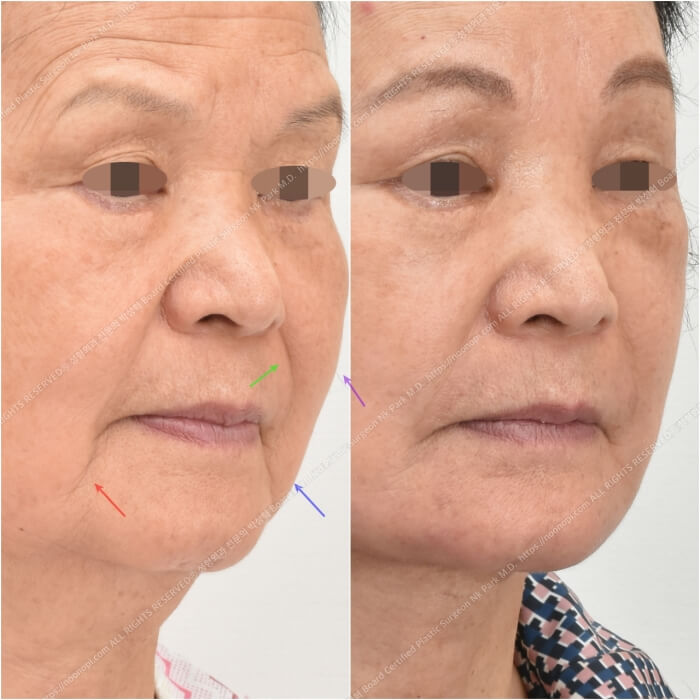 10 Things to Note About Facelift Results and Successful Before-and-After Cases image 9