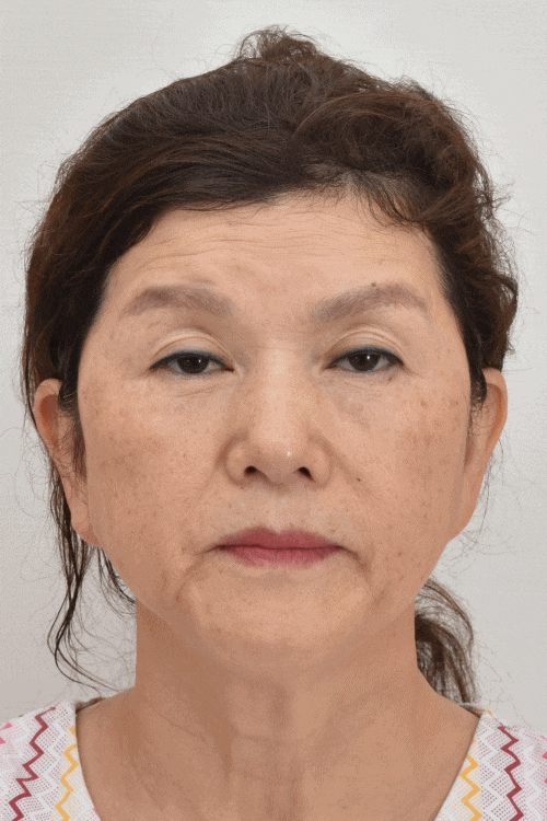 상안검수술하려는데 안검하수가 웬 말? 관련 이미지 13