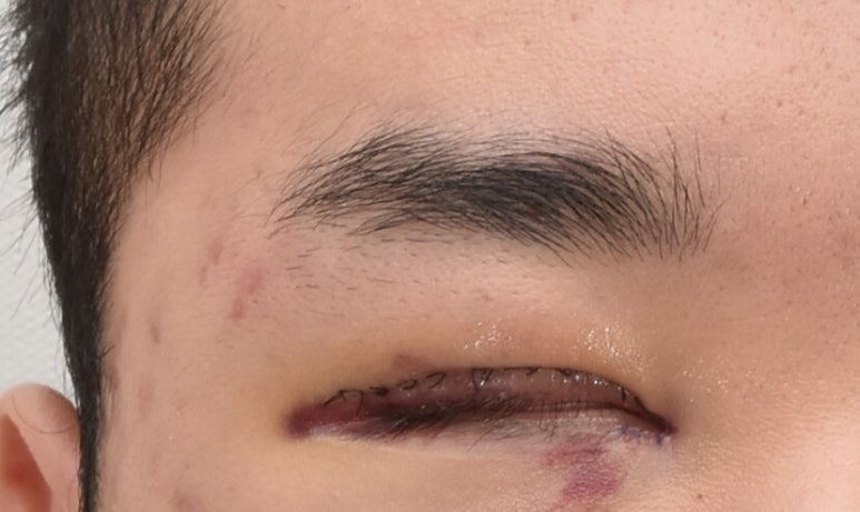 메디폼이야 듀오덤이야? 상처 소독, 무엇을 어떻게 관련 이미지 5