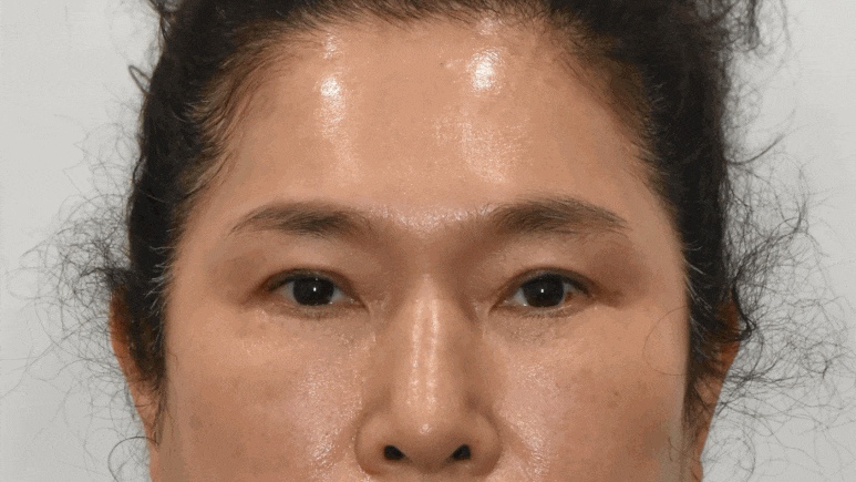 중년 눈수술! 사나워지자고 하는게 아니잖아요 :  조영구 성형에 관한 눈높이성형외과의 견해 관련 이미지 5