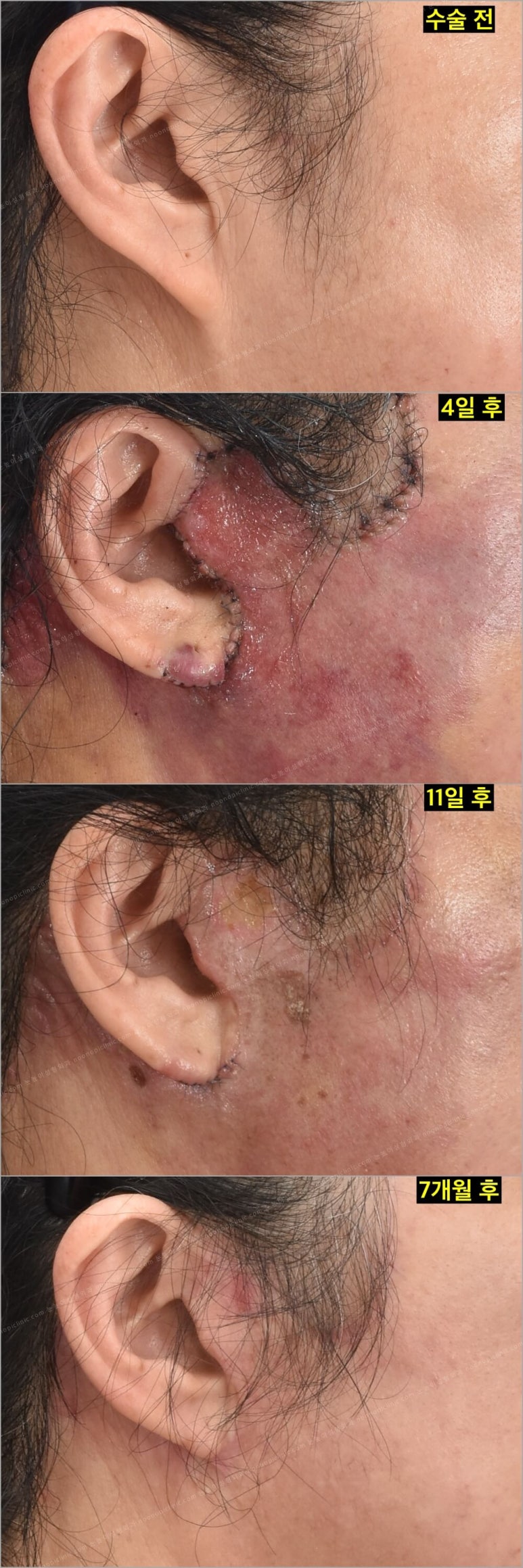 Facelift Scars and Recovery Time image 10
