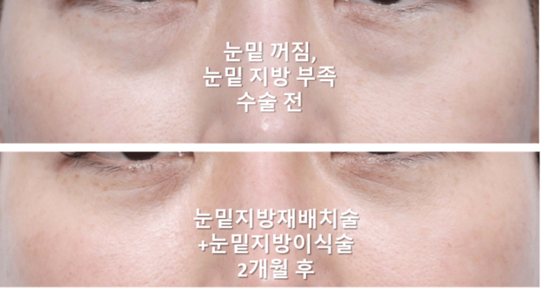 눈밑지방이식 어떤 경우에 효과적일까? 과도함, 부작용 방지 위해 관련 이미지 3