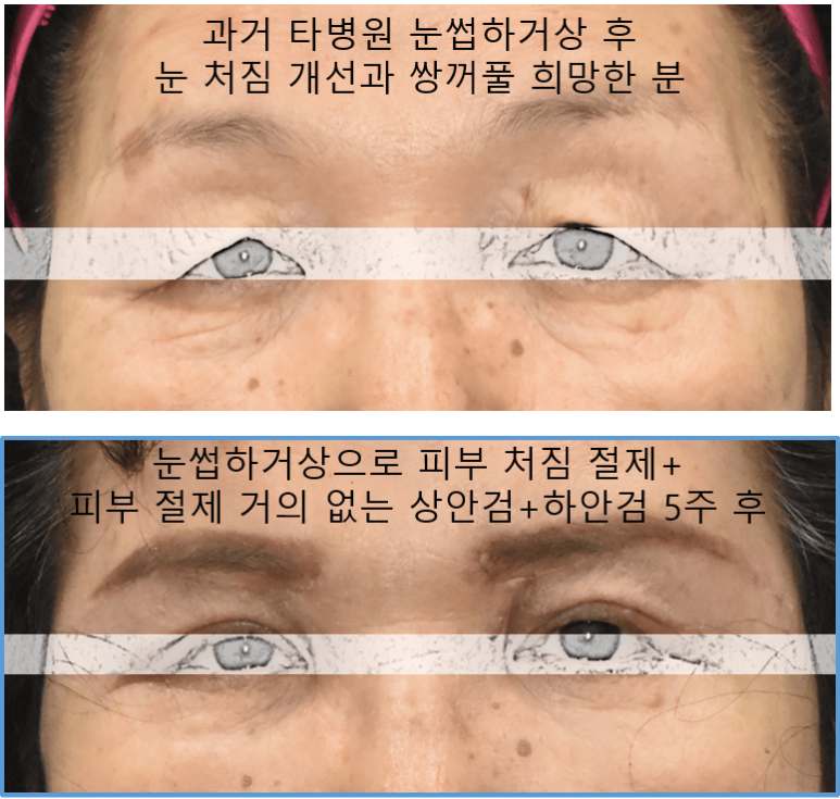 눈썹하거상술 절개 흉터가 신경 쓰이세요? 관련 이미지 7