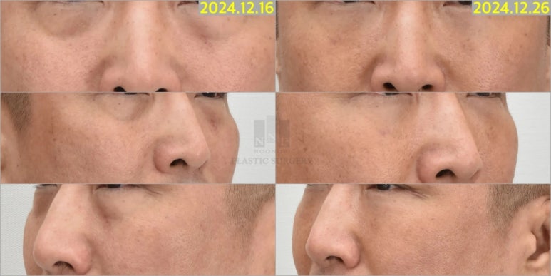 절개없이 눈밑처짐 해결하는법 관련 이미지 3