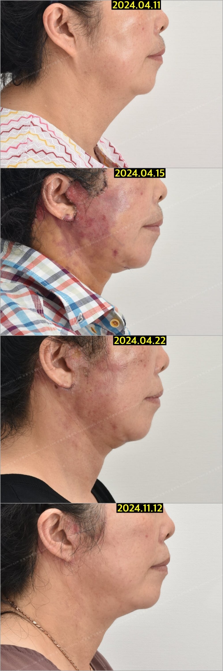 Facelift Scars and Recovery Time image 9