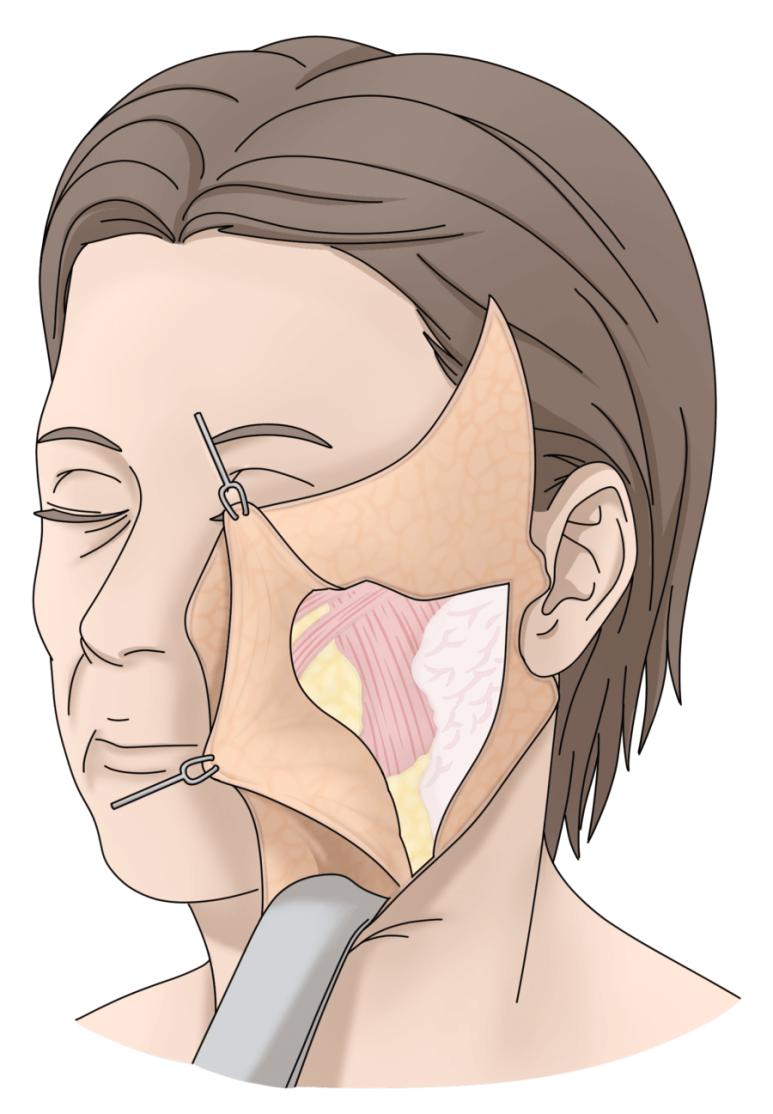 If You’re Looking Into Cosmetic Surgery as a Mother’s Day Gift for Your Parents image 11