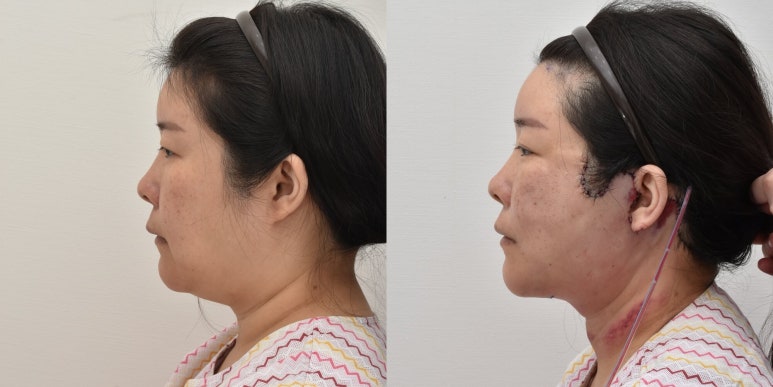 세상에서 가장 안면거상 수술을 잘하는 닥터 관련 이미지 23