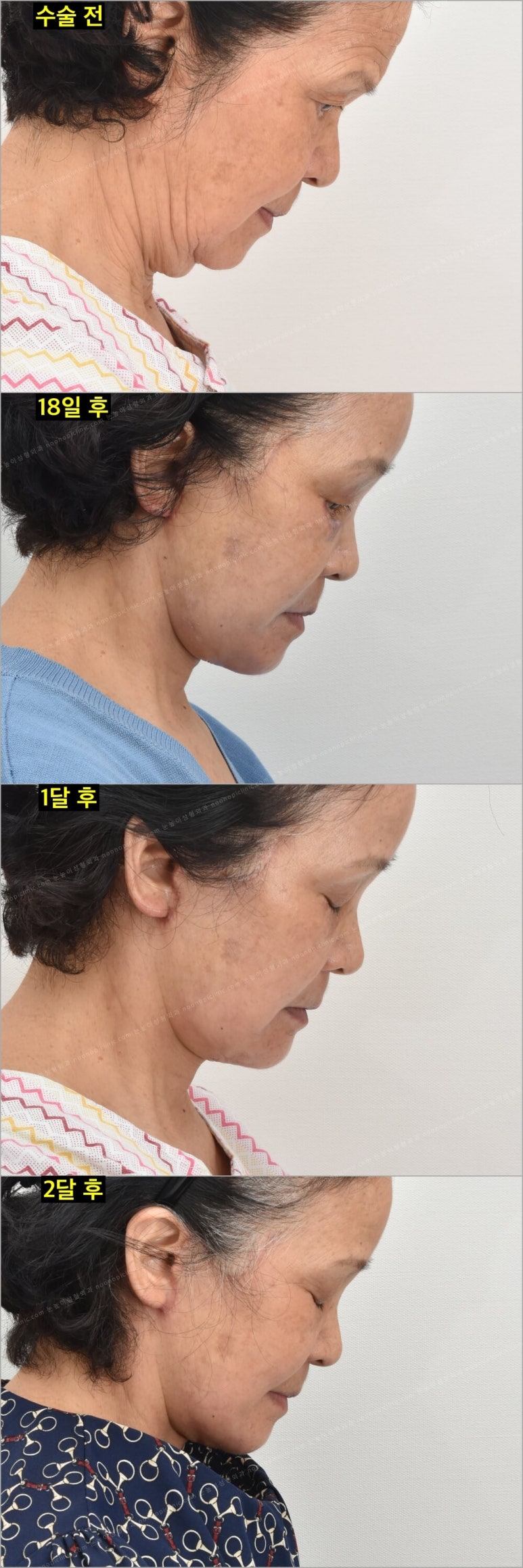 Facelift Scars and Recovery Time image 23