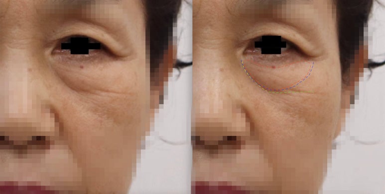 Lower Blepharoplasty vs. Fat Repositioning for Under-Eye Bags - Which Under-Eye Surgery Is Right for Me? image 1