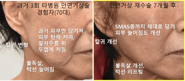 안면거상술 생각하는데 부작용 걱정 되세요? 관련 이미지 2