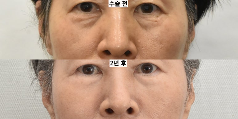 눈밑지방이식은 어떤 경우 하는 게 좋을까 관련 이미지 8