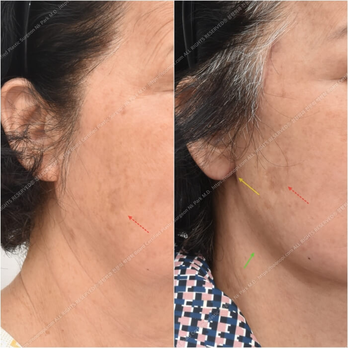 10 Things to Note About Facelift Results and Successful Before-and-After Cases image 10