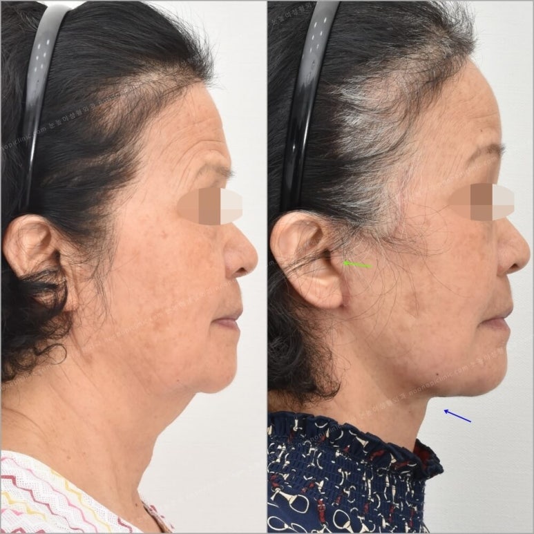 10 Things to Note About Facelift Results and Successful Before-and-After Cases image 11