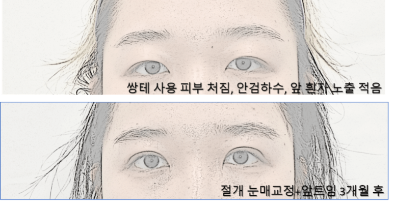 Creating Double Eyelids: What to Know If You’ve Been Using Tape and Eventually Decide on Surgery image 4