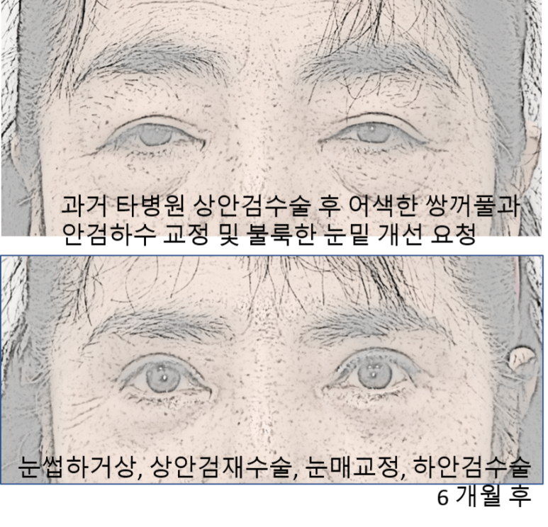 Do I Need Ptosis Correction When Getting Upper Blepharoplasty? image 6