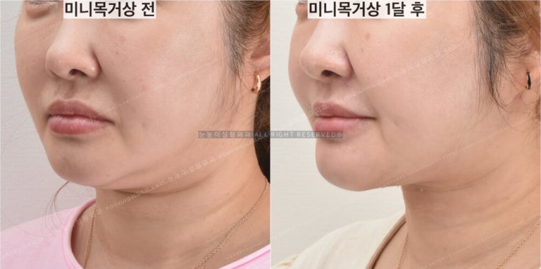 성형외과에서는 이중턱 리프팅을 이렇게 권한다(목거상수술) 관련 이미지 13