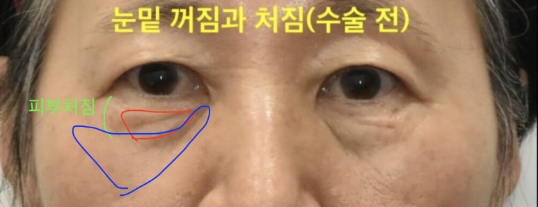 가족에게 추천한 눈밑하안검수술 24개월 경과 관련 이미지 5