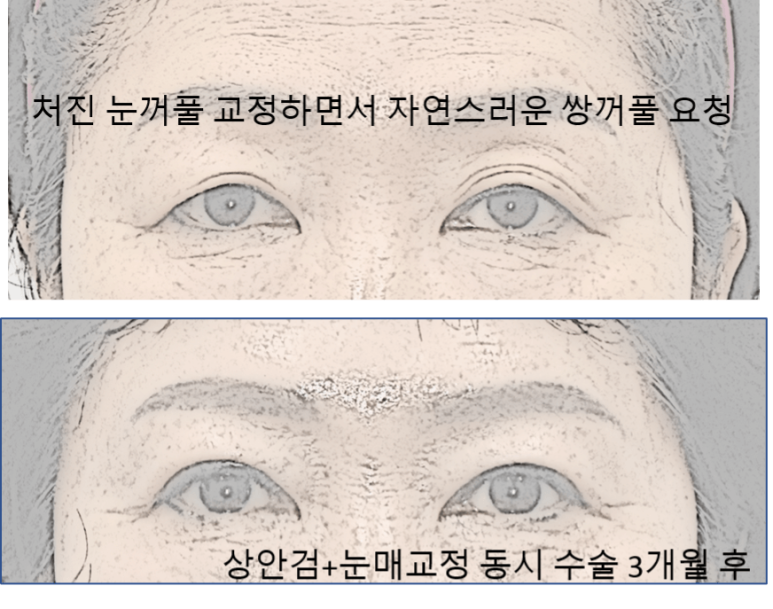 Do I Need Ptosis Correction When Getting Upper Blepharoplasty? image 5