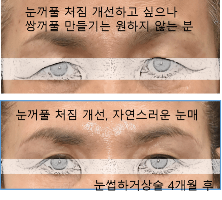 눈썹하거상술 절개 흉터가 신경 쓰이세요? 관련 이미지 4