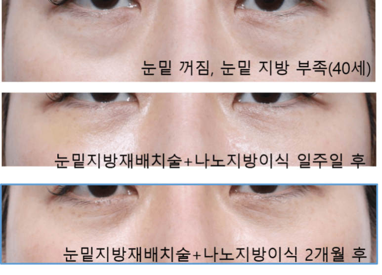 40대 눈밑지방재배치술 효과, 경과 관련 이미지 5