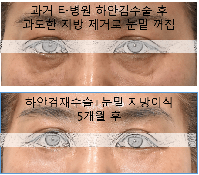 하안검수술 부작용 예방과 대처 방법 관련 이미지 4