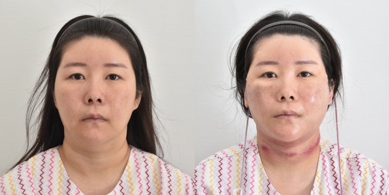 세상에서 가장 안면거상 수술을 잘하는 닥터 관련 이미지 21