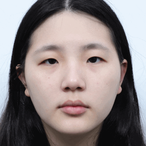 What Is Ptosis Correction? (Graphic Images Warning ⚠️) image 5